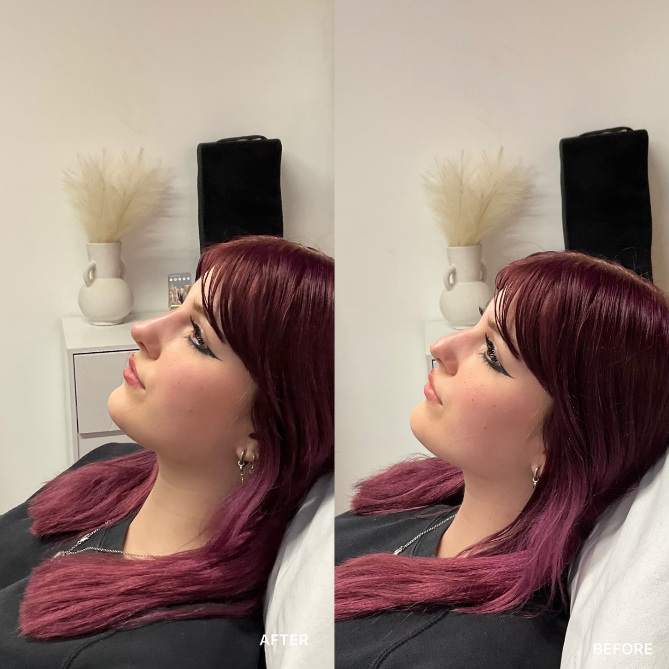 Non-Surgical Rhinoplasty