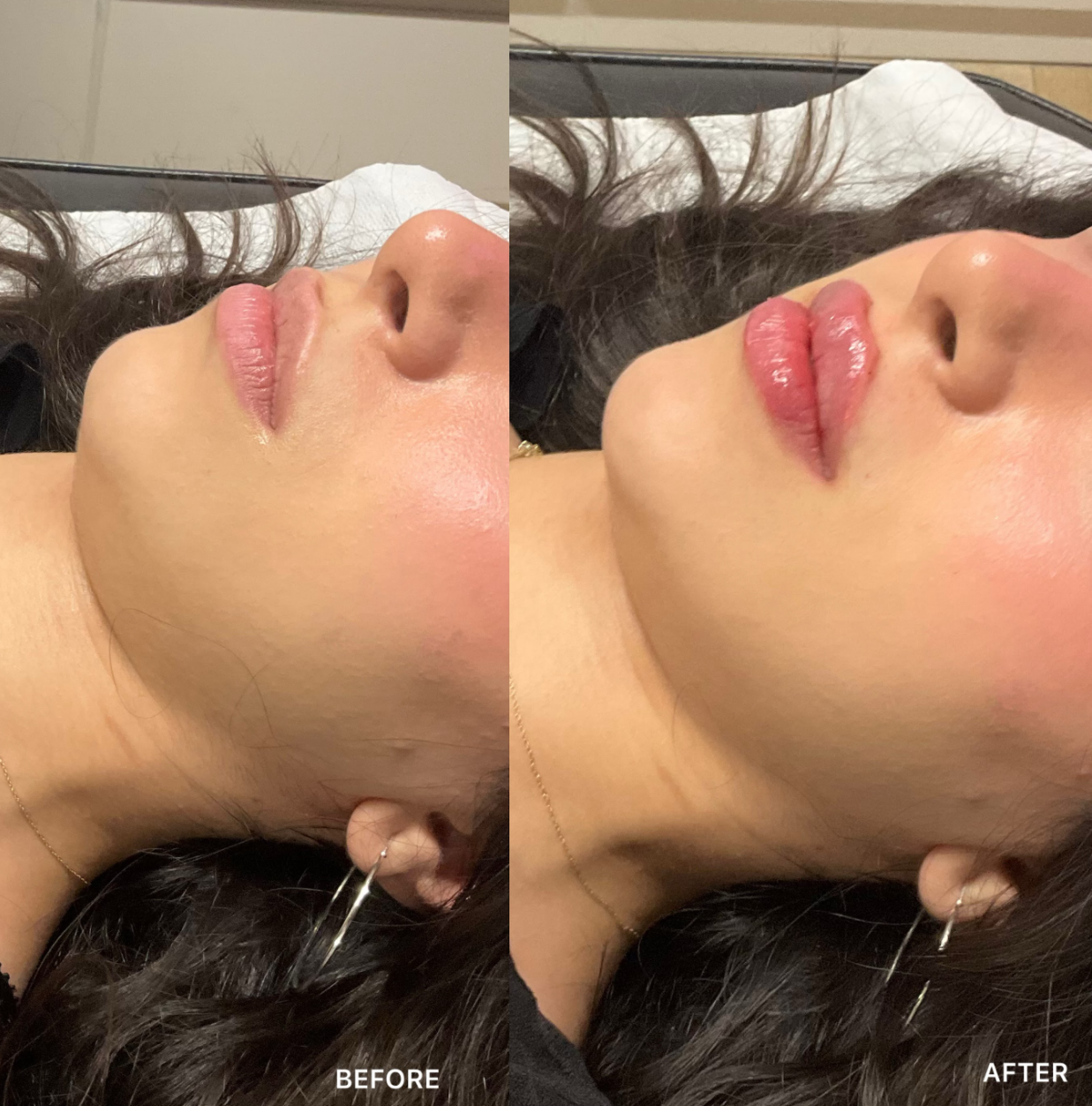 Russian / Natural Lip Filler