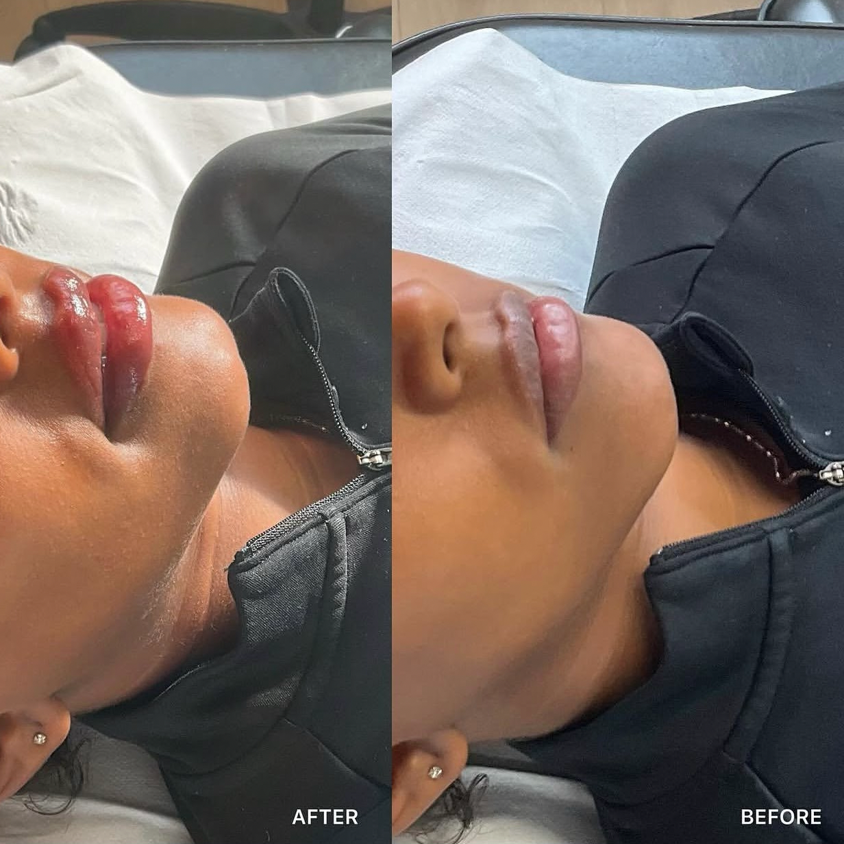 Russian / Natural Lip Filler