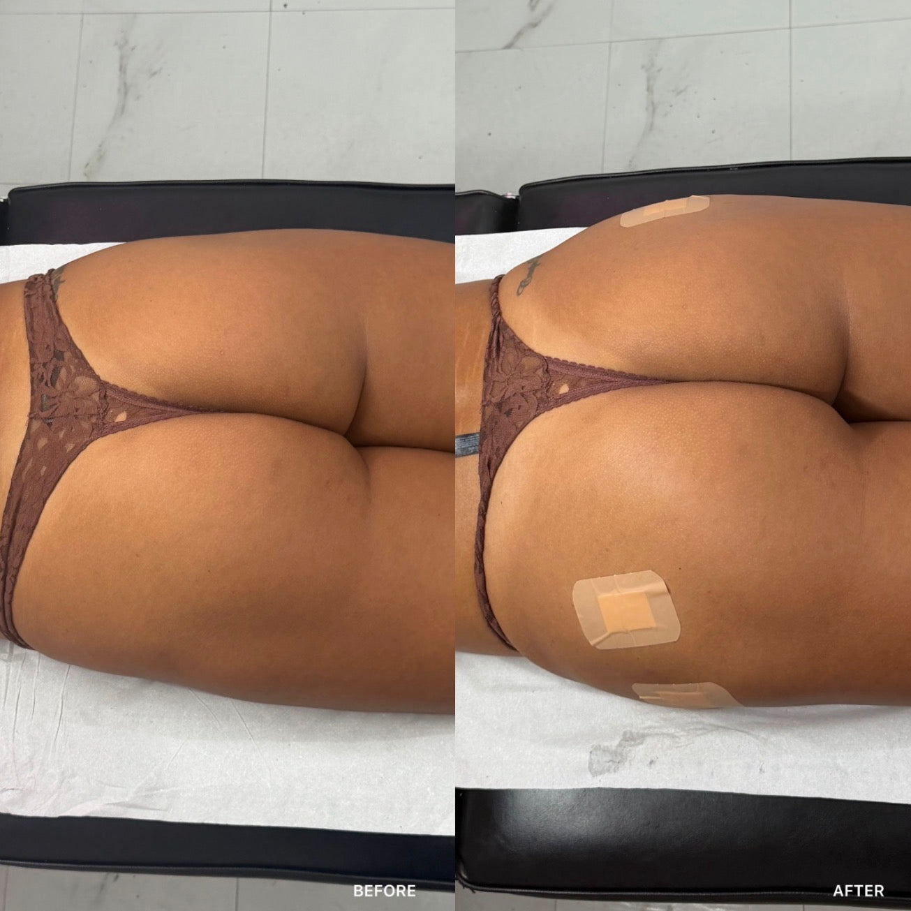BBL and Hip Dip Filler