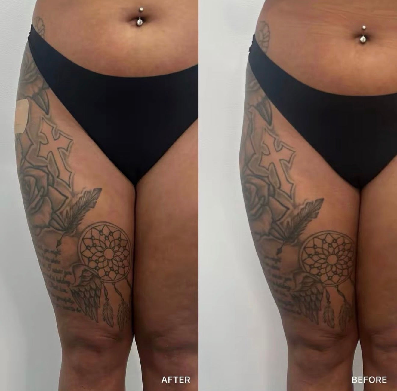 BBL and Hip Dip Filler
