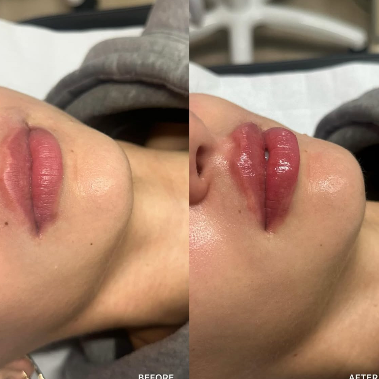 Russian / Natural Lip Filler