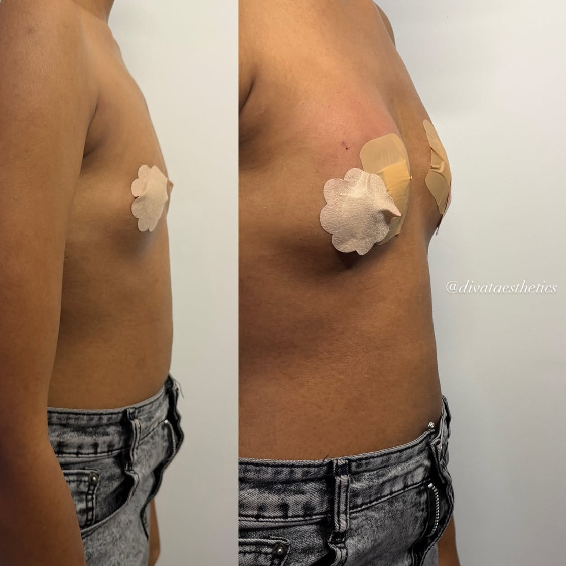 Breast Filler