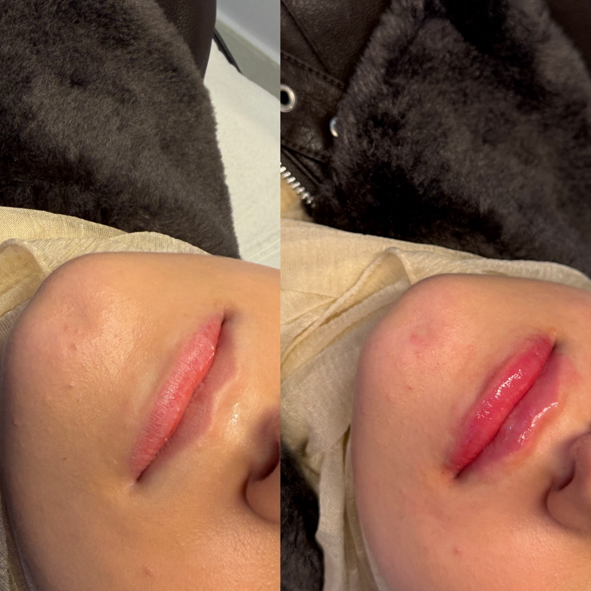 Russian / Natural Lip Filler
