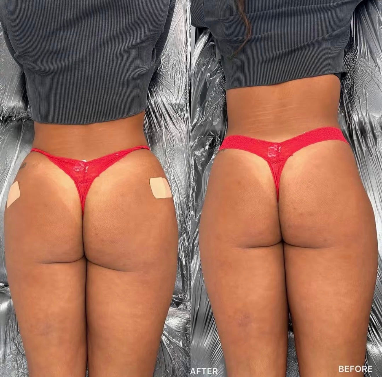 BBL and Hip Dip Filler