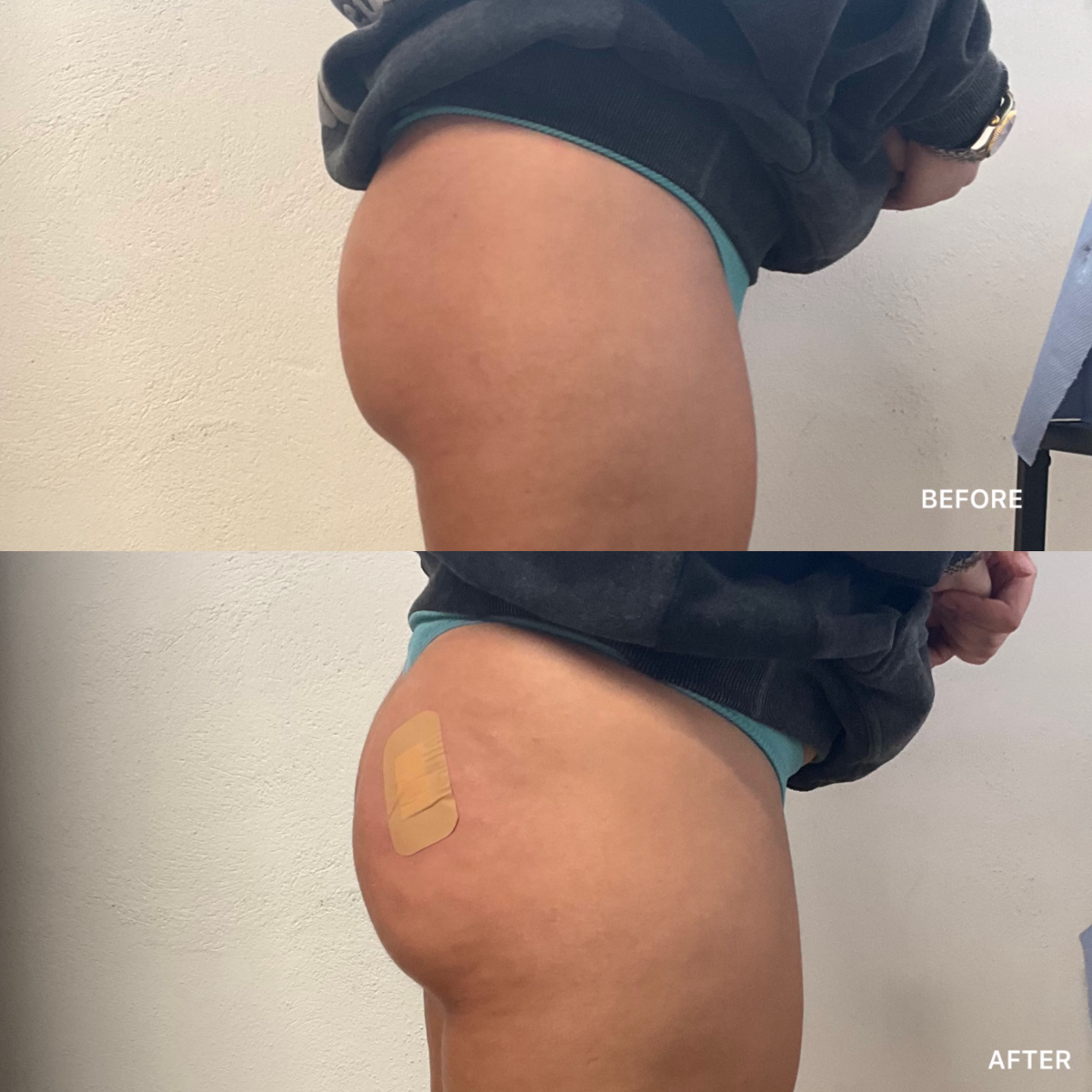 BBL and Hip Dip Filler