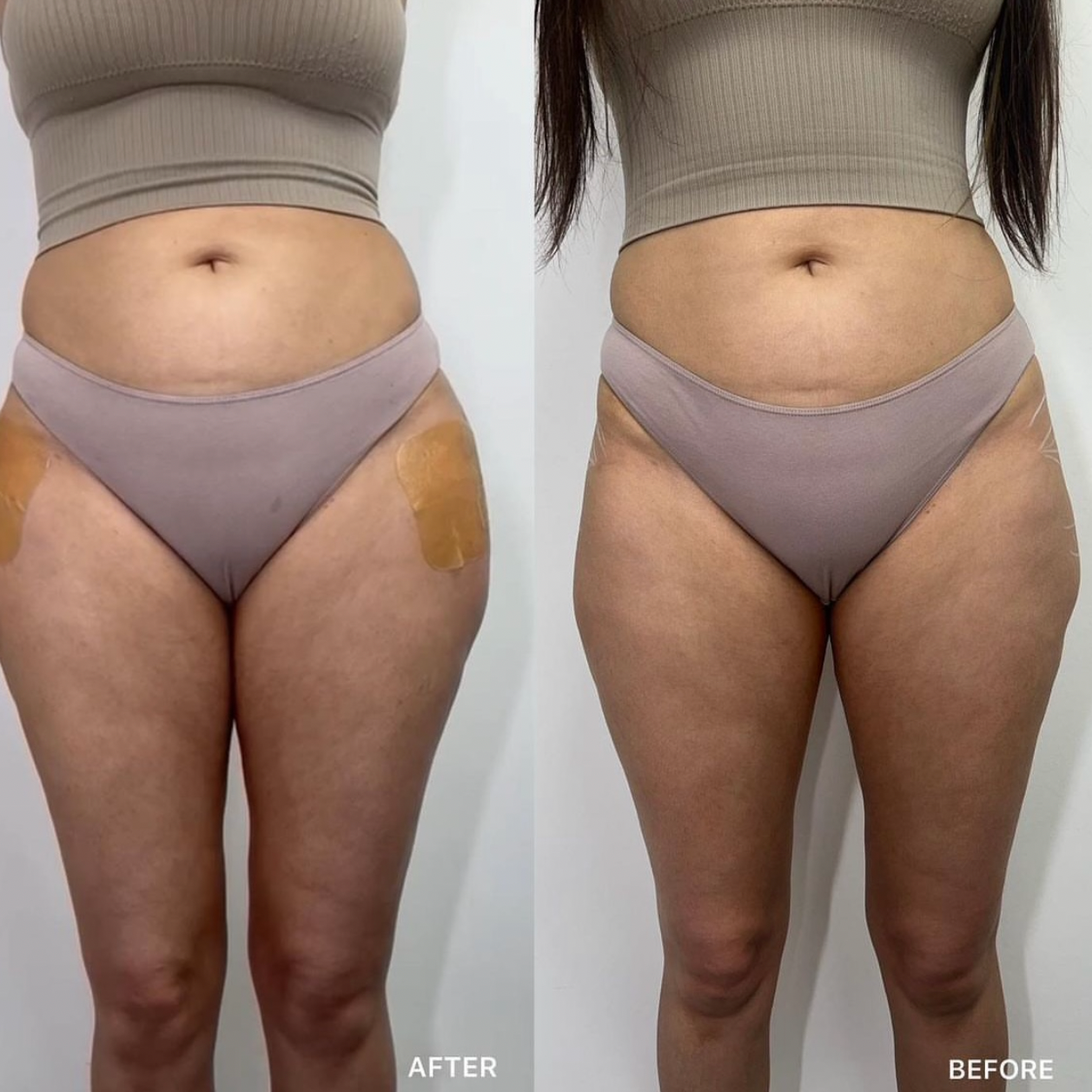 BBL and Hip Dip Filler