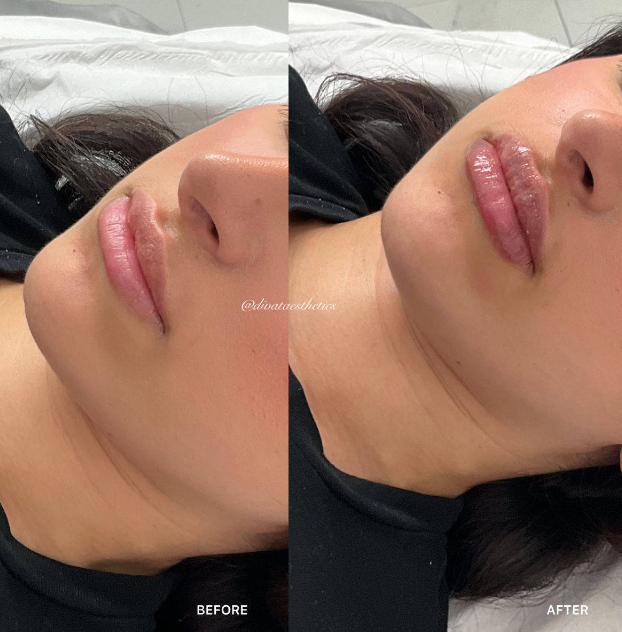 Russian / Natural Lip Filler