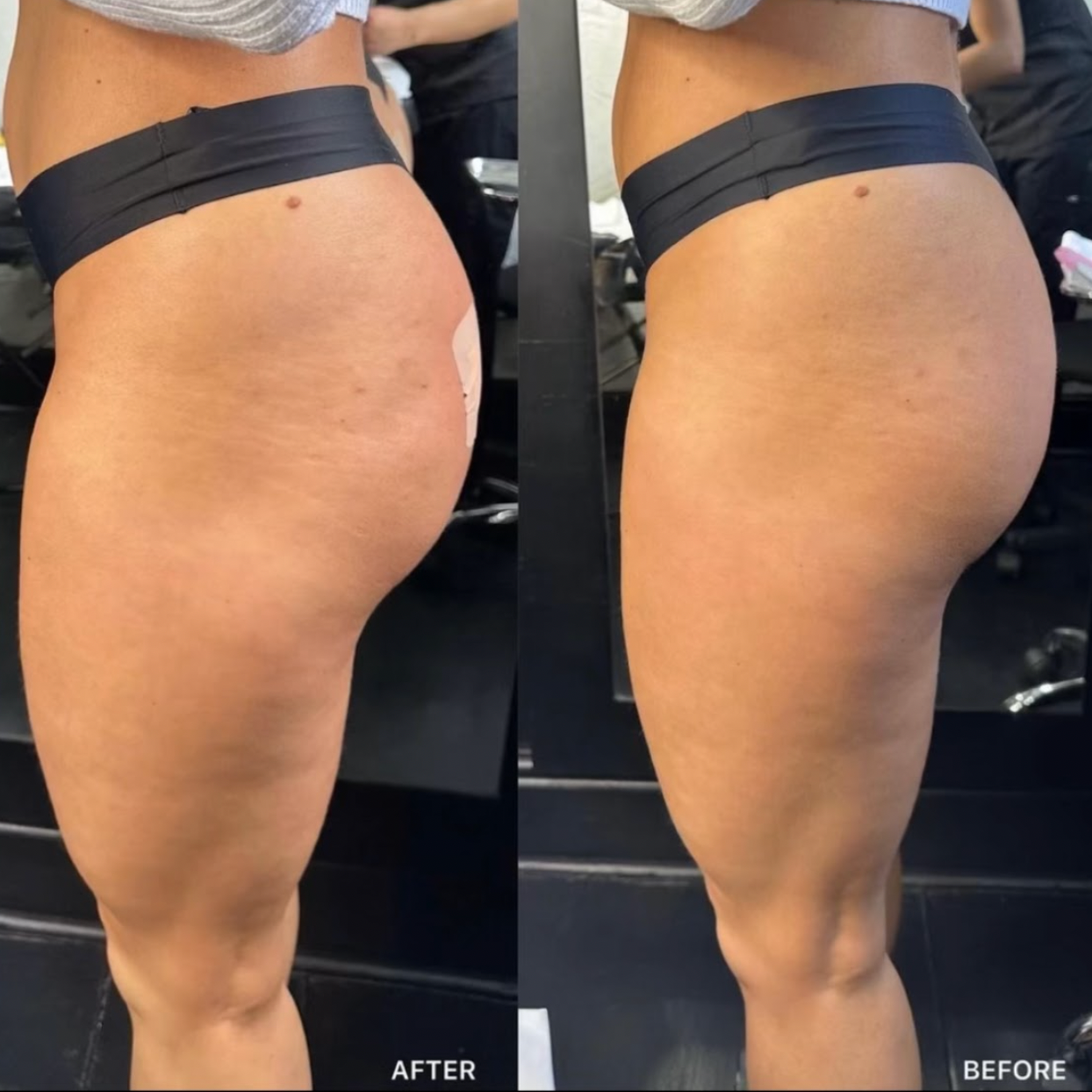 BBL and Hip Dip Filler