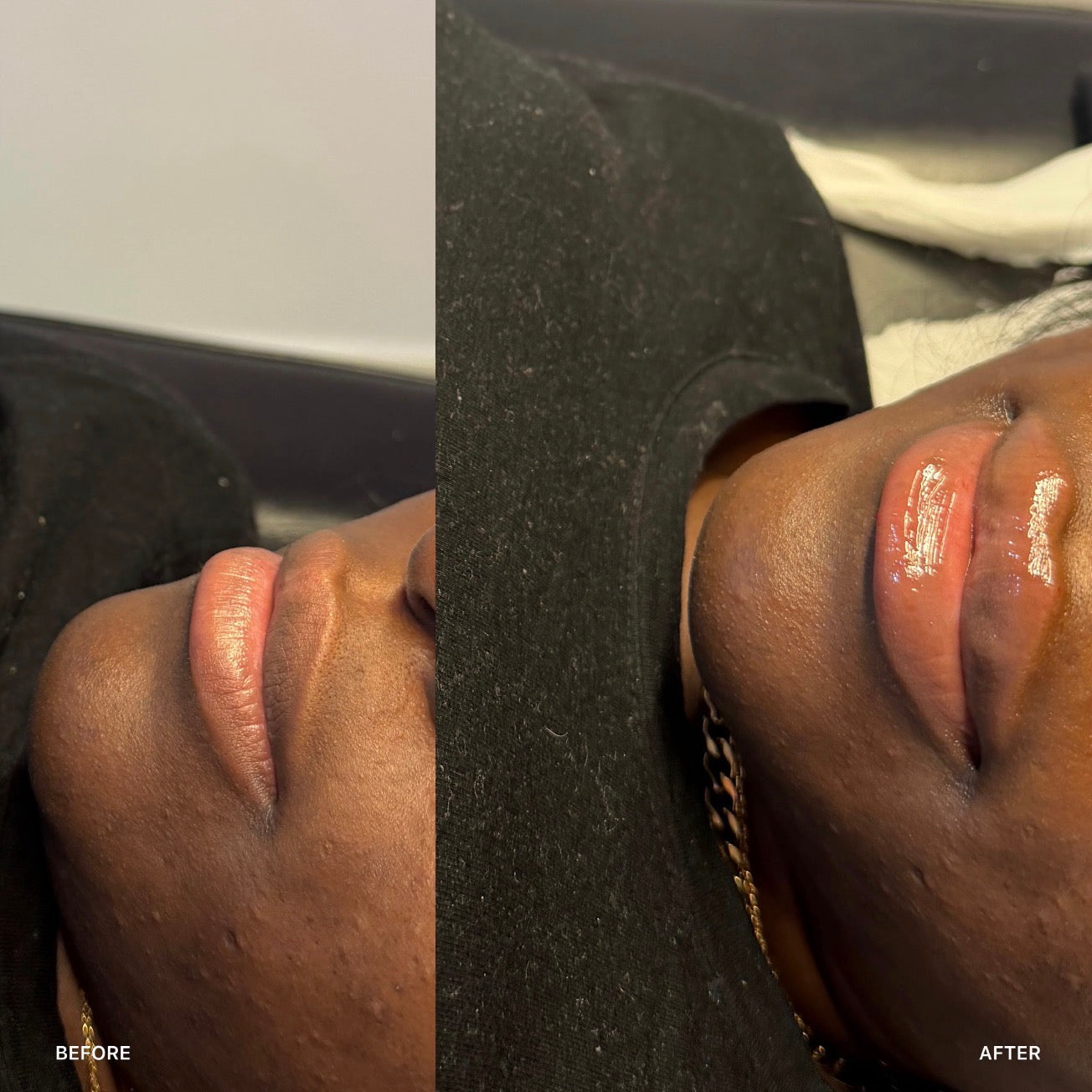 Russian / Natural Lip Filler