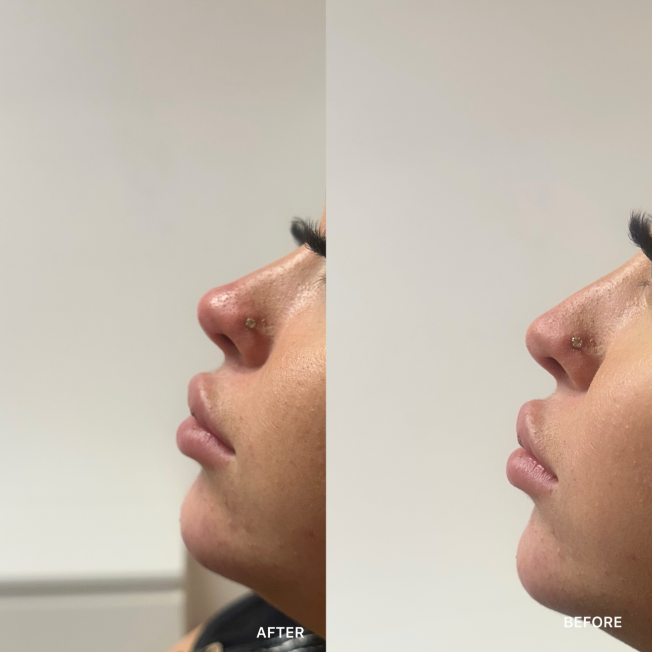 Non-Surgical Rhinoplasty