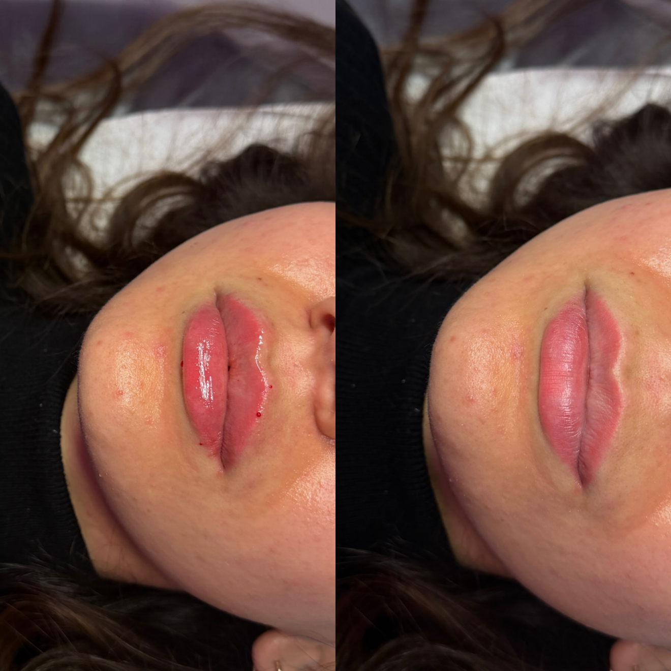 Russian / Natural Lip Filler