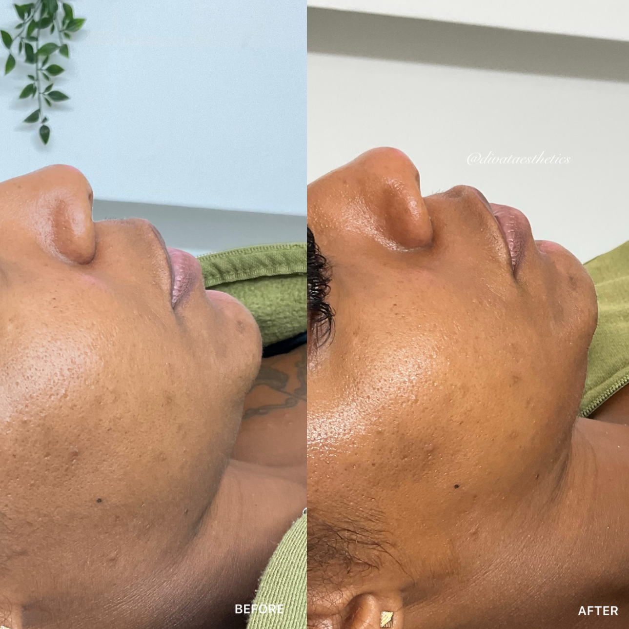 Dermaplaning & Microneedling