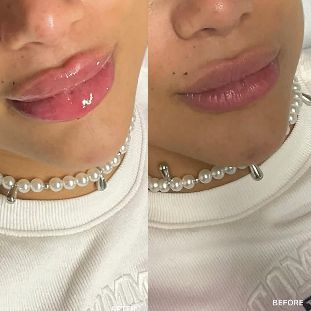 Russian / Natural Lip Filler