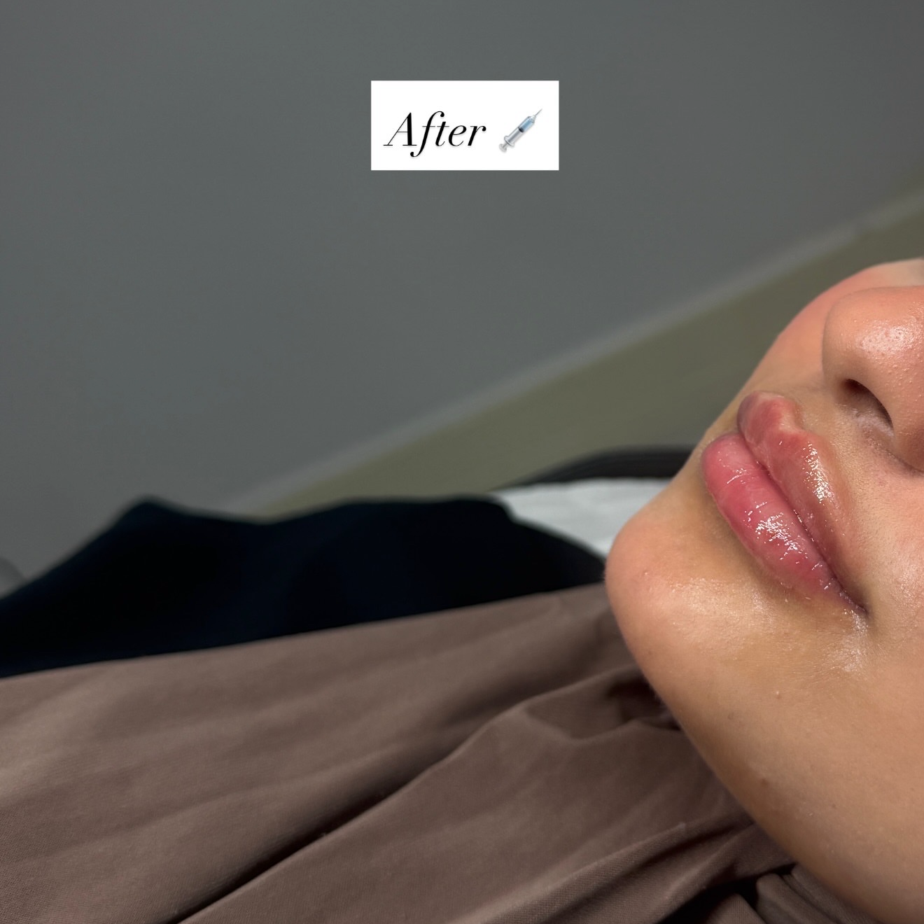 Russian / Natural Lip Filler