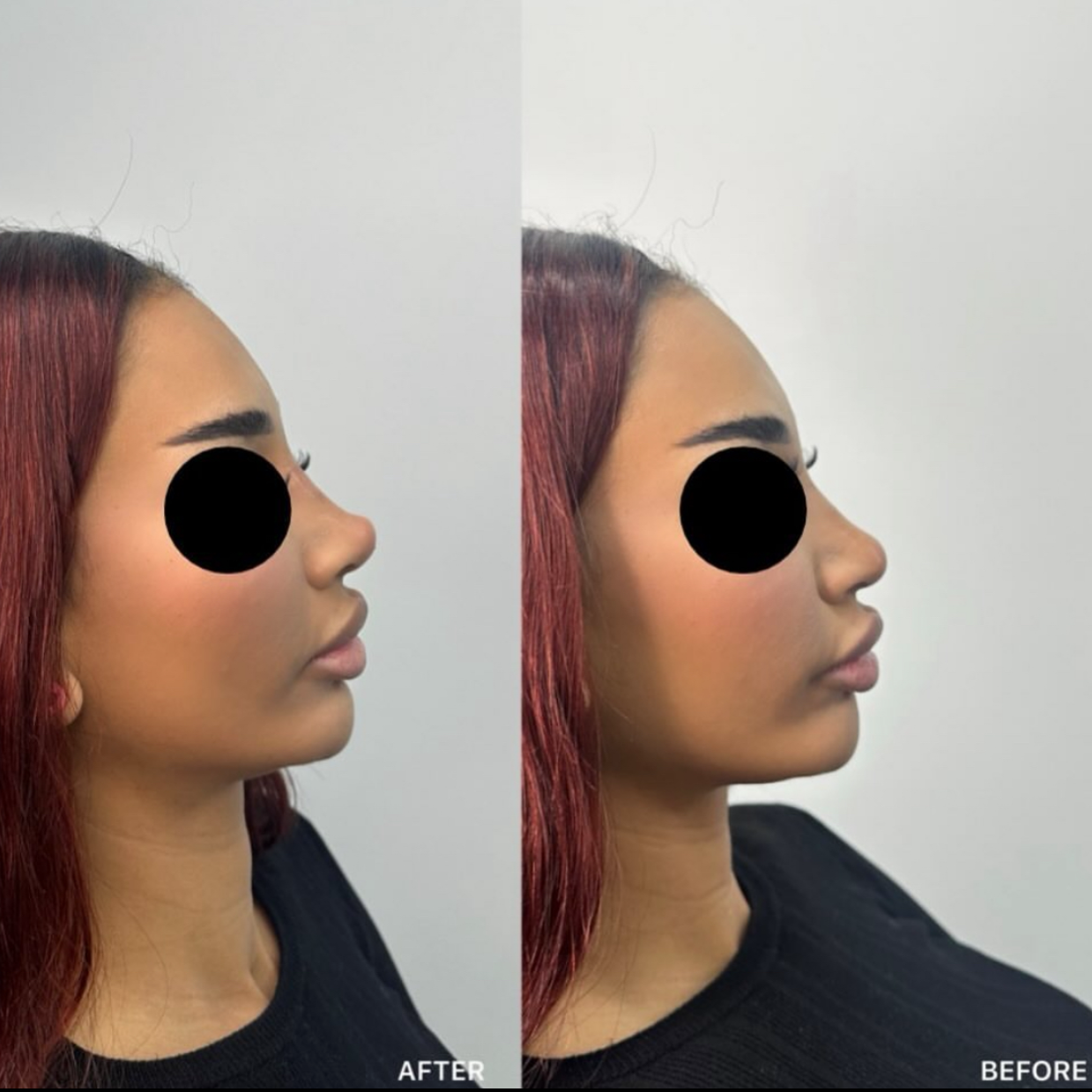 Non-Surgical Rhinoplasty