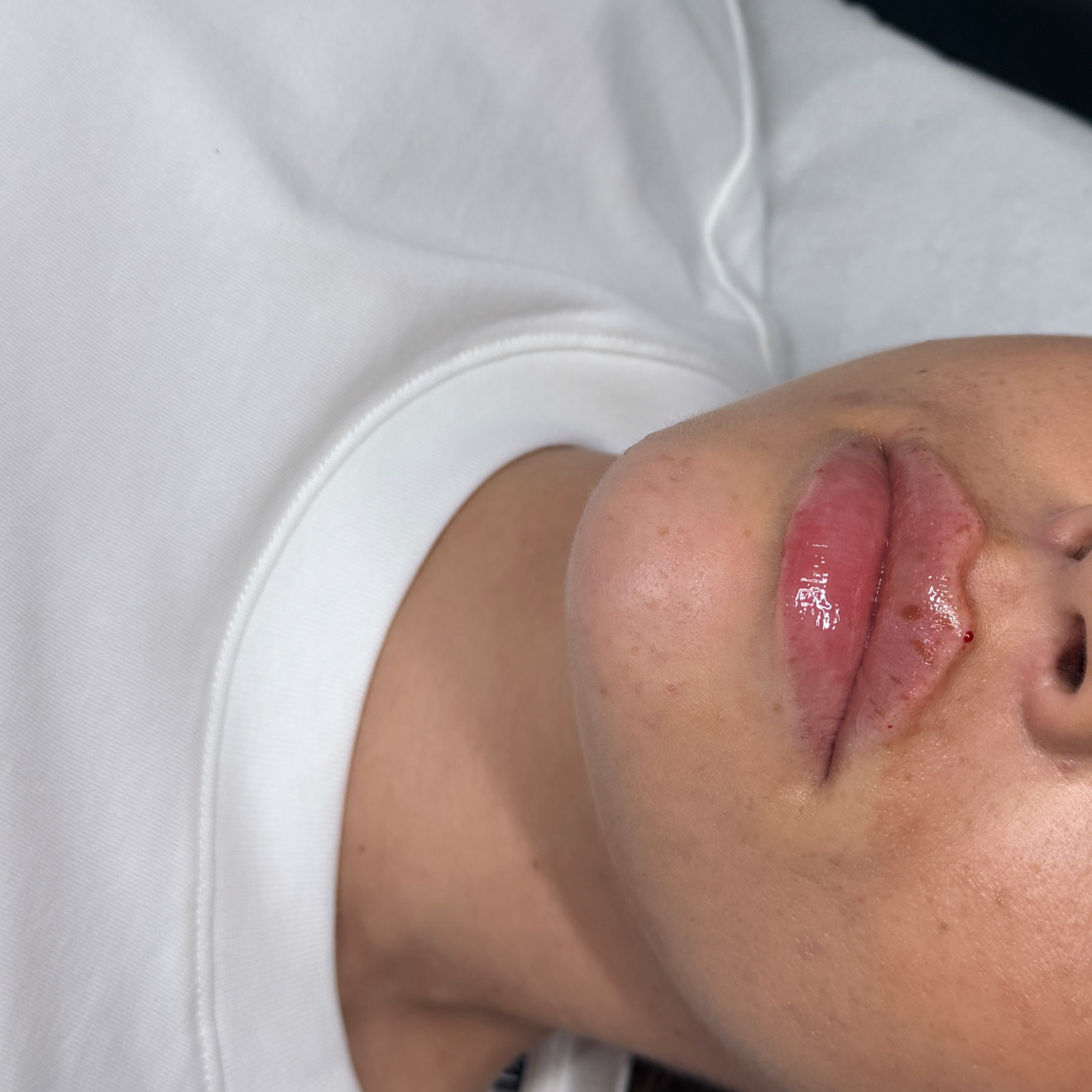 Russian / Natural Lip Filler